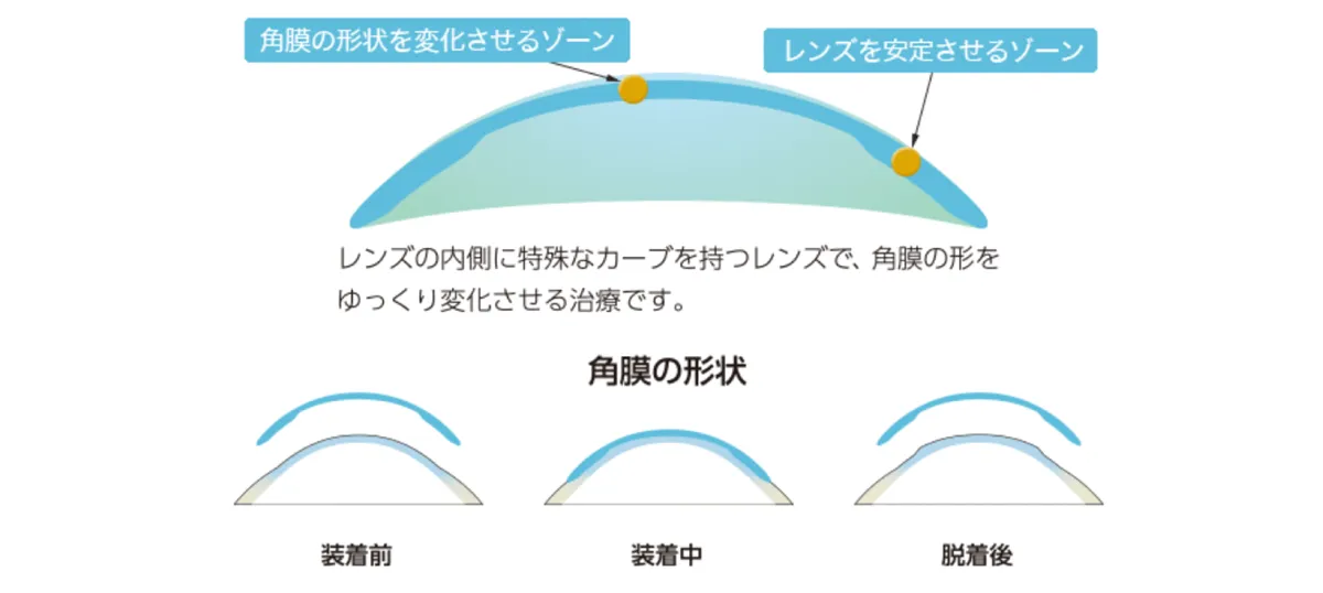 オルソケラトロジー